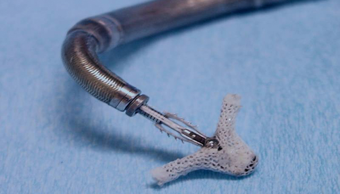 This is a photo of the MitraClip, the transcatheter mitral valve repair therapy.
