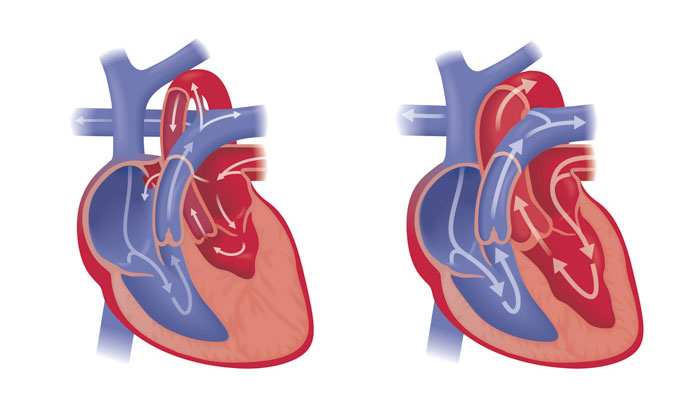 Fetal hypoplastic left heart syndrome illustration