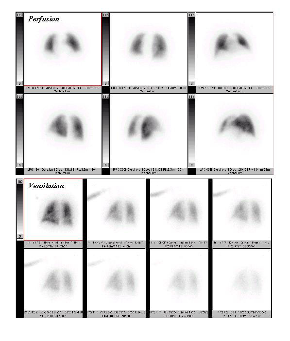 Nuclear Medicine Patient Education Lung Scan