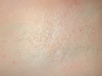 Hair Removal After