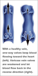 visual comparison of healthy vein and varicose vein