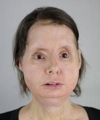 Charla Nash face transplant recipient