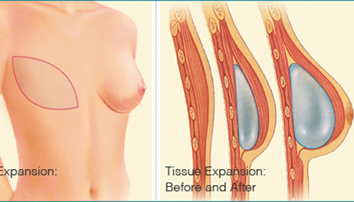 Before and After - Breast Implants after Mastectomy