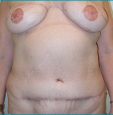 Recontructive Procedures Breast DIEP Bilateral Delayed After