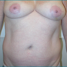 Recontructive Procedures Breast DIEP Bilateral Immediate Before