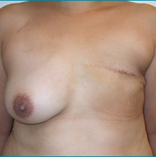 Recontructive Procedures Breast DIEP Unilateral Delayed Before