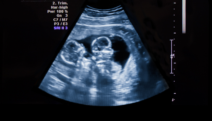 sonogram of twins
