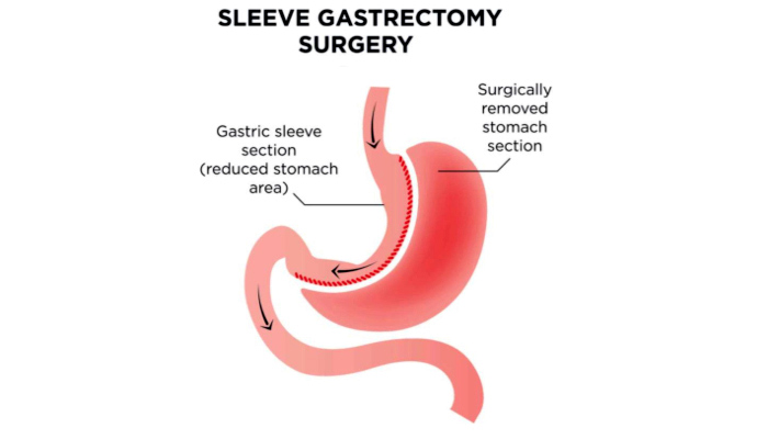This is a medical illustration of a sleeve gastrectomy procedure.