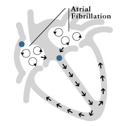 Figure 2: atrial fibrillation