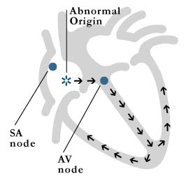Figure 6: atrial tachycardia