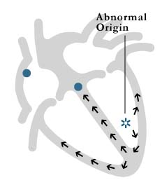 Figure 7: ventricular tachycardia
