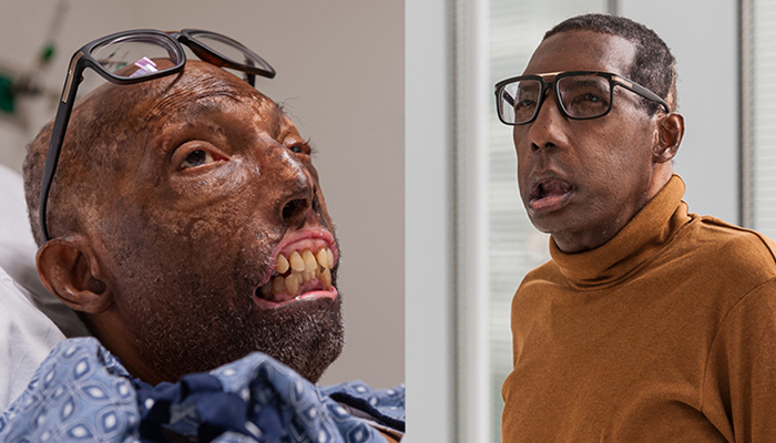 Before and after photos of face transplant recipient