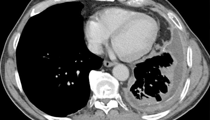 epithelioid diffuse malignant pleural mesothelioma