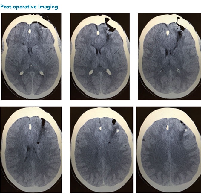 stroke post-operative brain scan