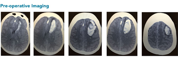 stroke pre-operative brain scan