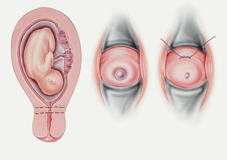 Laparoscopic abdominal cerclage