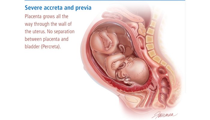 Placenta Accreta Pregnancy Complication - Brigham and Women's Hospital