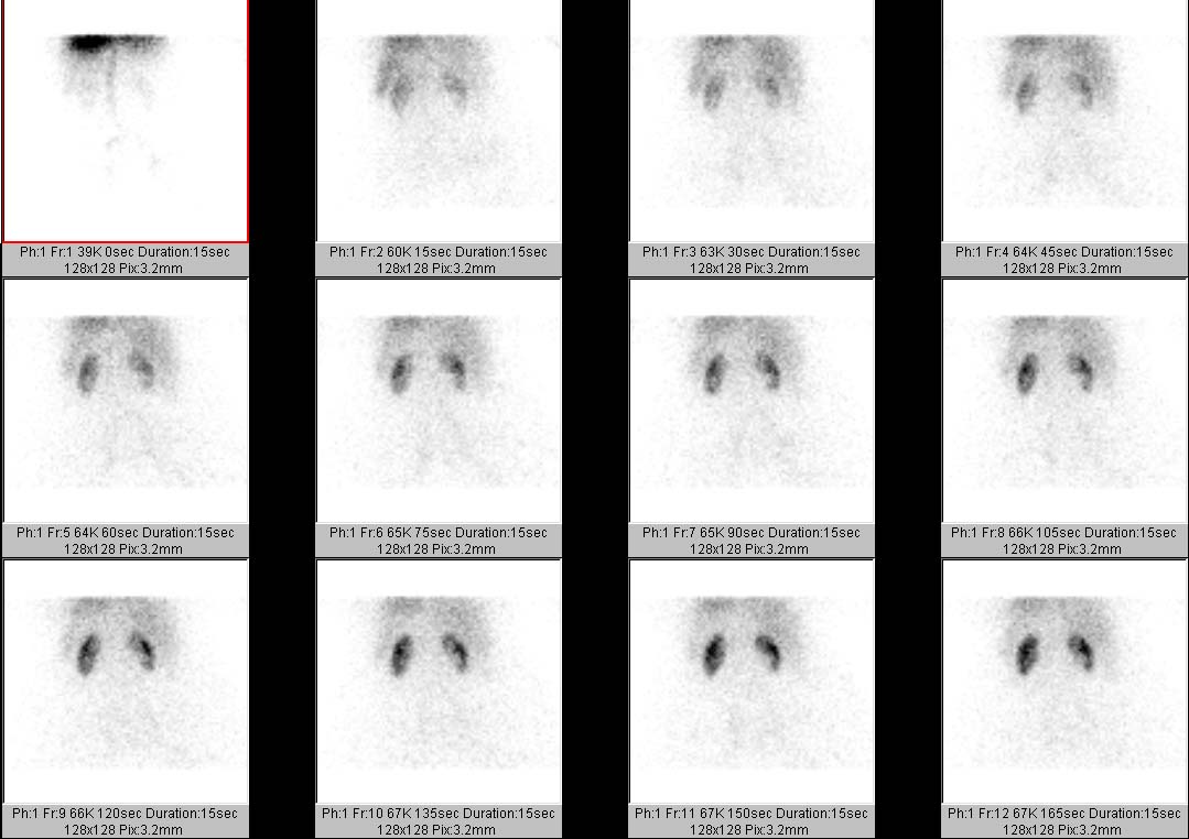 Nuclear Medicine Patient Education Renal Imaging