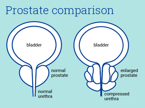 Prostate comparison
