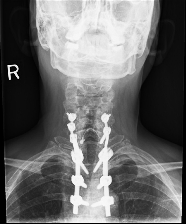 X-ray of upper spine