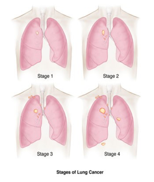 Image of lung cancer stages.