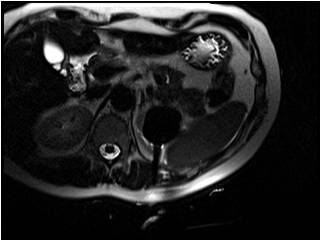 MRI-guided renal cryoablations.