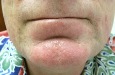 Vascular Lesions After