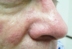 Vascular Lesions After