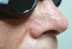 Vascular Lesions Before
