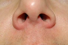 Vascular Lesions After