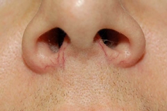 Vascular Lesions Before