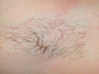 Hair Removal Before