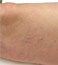 Spider Vein Before