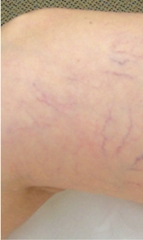 Spider Vein Before