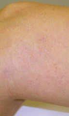 Spider Vein After