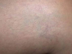 Spider Vein After