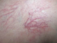 Spider Vein Before