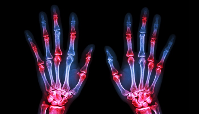 Skeletal view of inflamed wrists / Rheumatology & Musculoskeletal Diseases