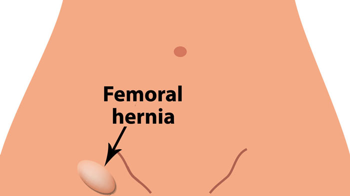 illustration of femoral hernia