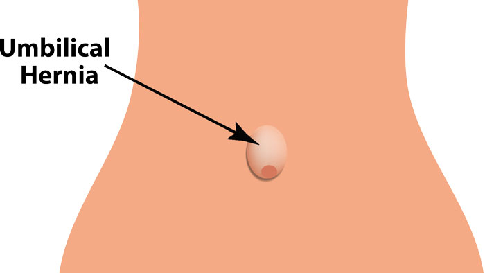 illustration of umbilical hernia