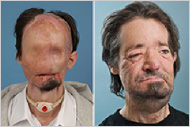 Surgery - History - Face transplants