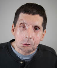 Jim Maki face transplant recipient