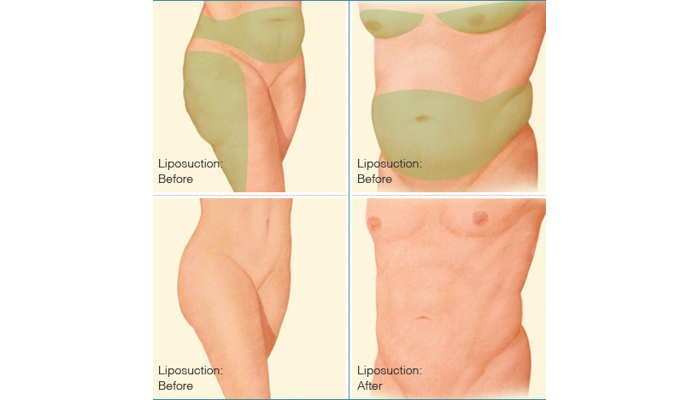 Liposuction Benefits