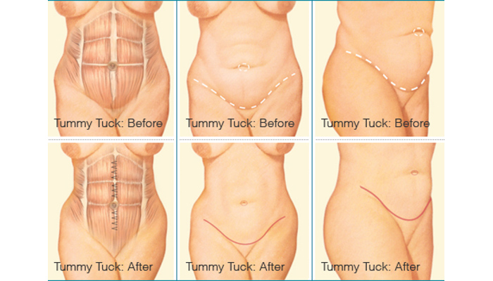 Tummy Tuck Alternative