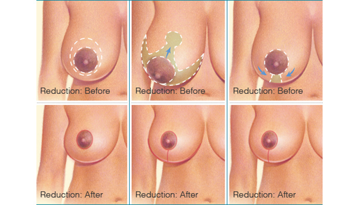 example of before and after reduction procedure