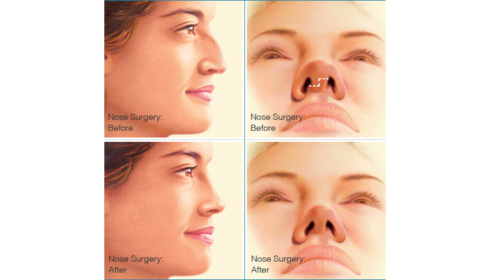 nose surgery