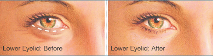 eyelid lower