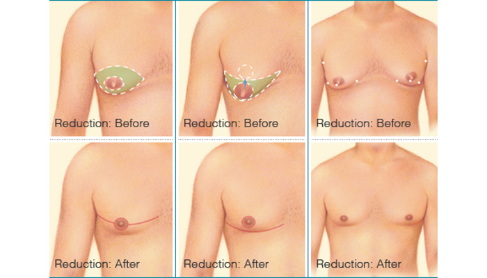 breast reduction for men