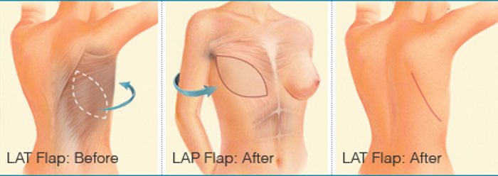 Breast LAT Flap Reconstruction