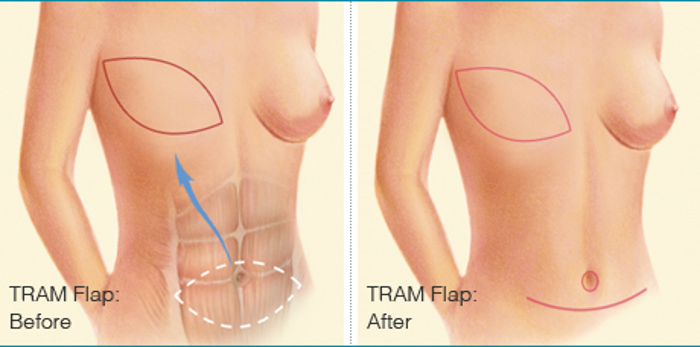 TRAM Flap Reconstructive Breast Procedure
